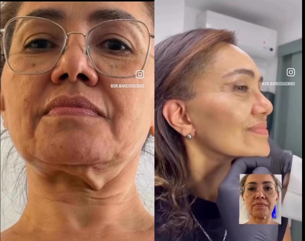 Antes e depois — deep plane (provisório)