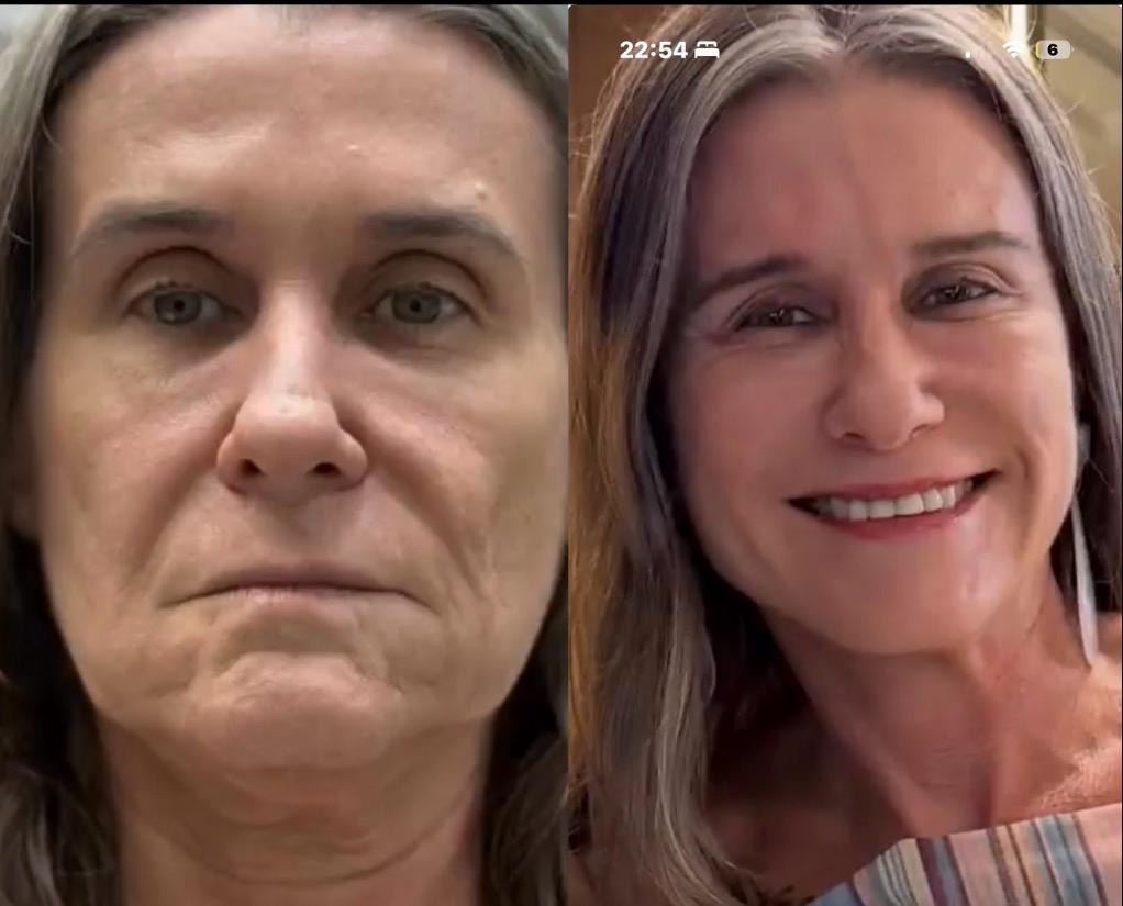 Antes e depois — deep neck (provisório)