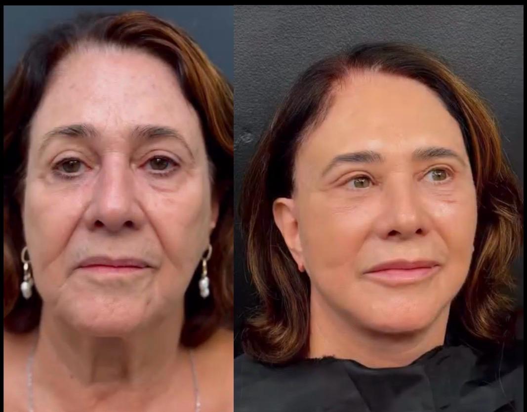 Antes e depois — cirurgia do olhar (provisório)