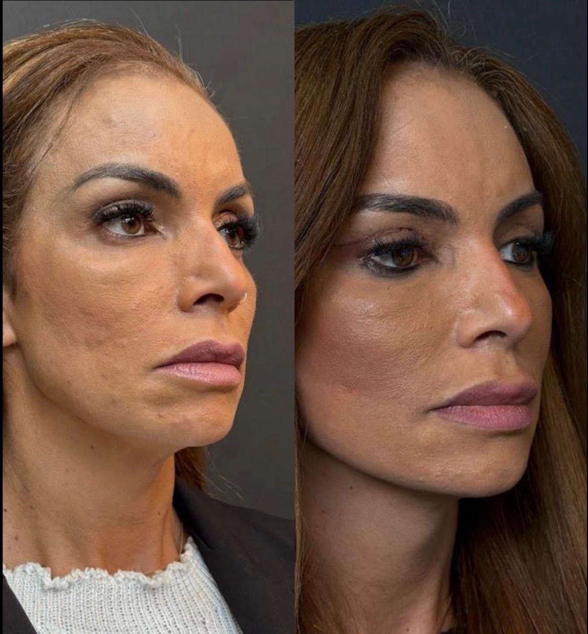 Antes e depois — brow lift (provisório)