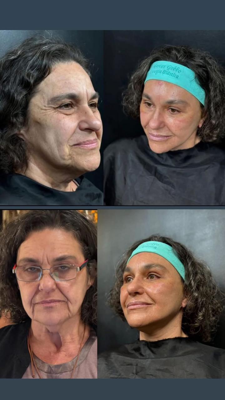 Antes e depois — soof lift (provisório)