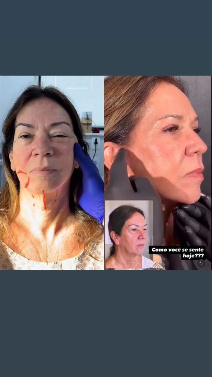 Antes e depois — lifting coronal (provisório)