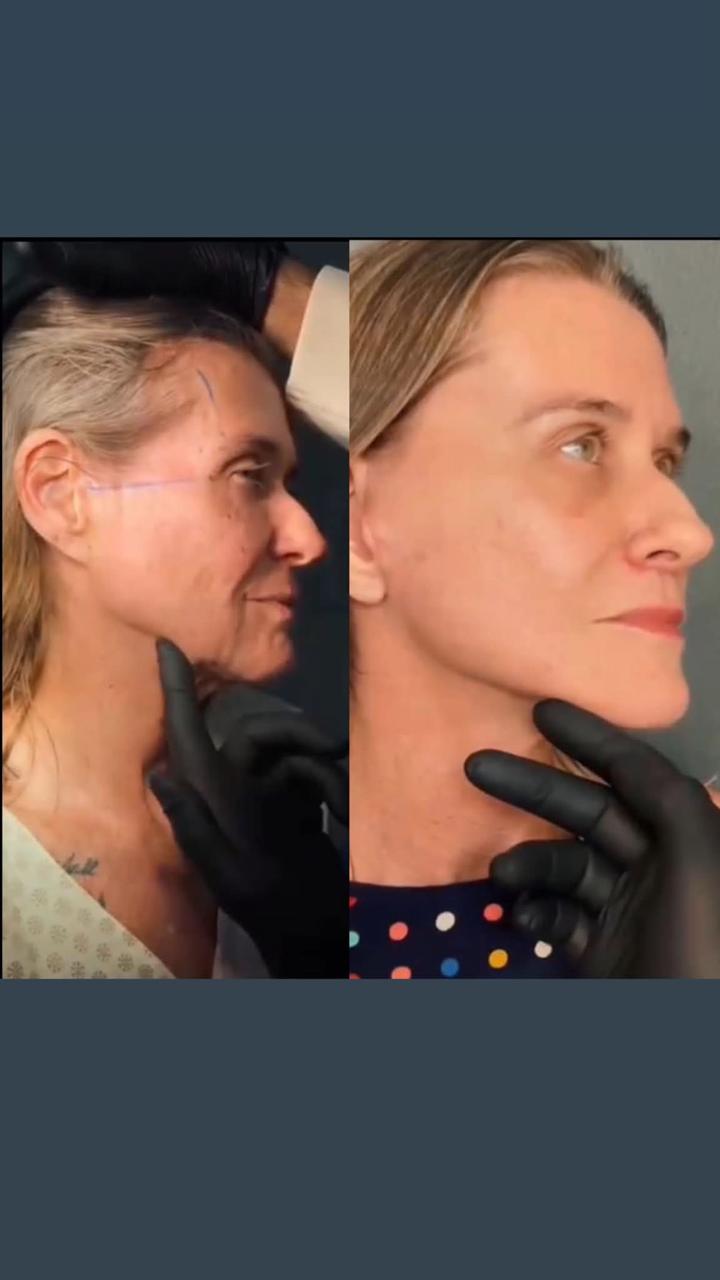 Antes e depois — resultado associado à tecnologia (provisório)