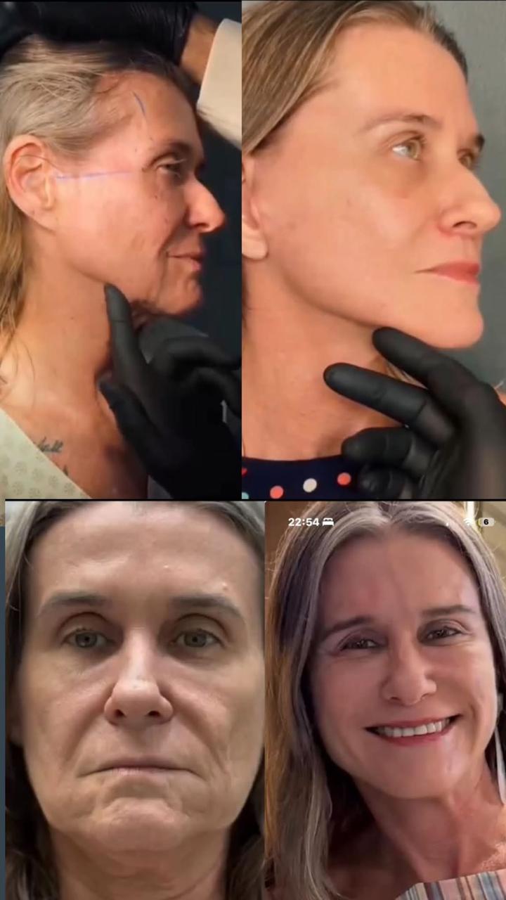 Antes e depois — resultado associado à tecnologia (provisório)