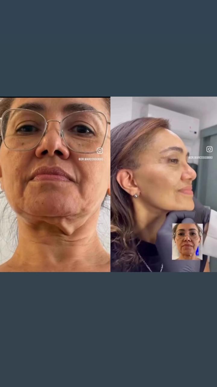 Antes e depois — resultado associado à tecnologia (provisório)